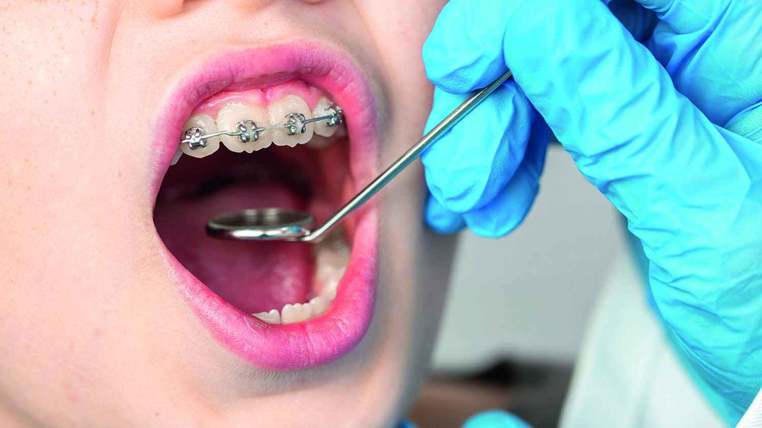Dégagement orthodontique d’une canine incluse - Dr Sylvie Mauhourat