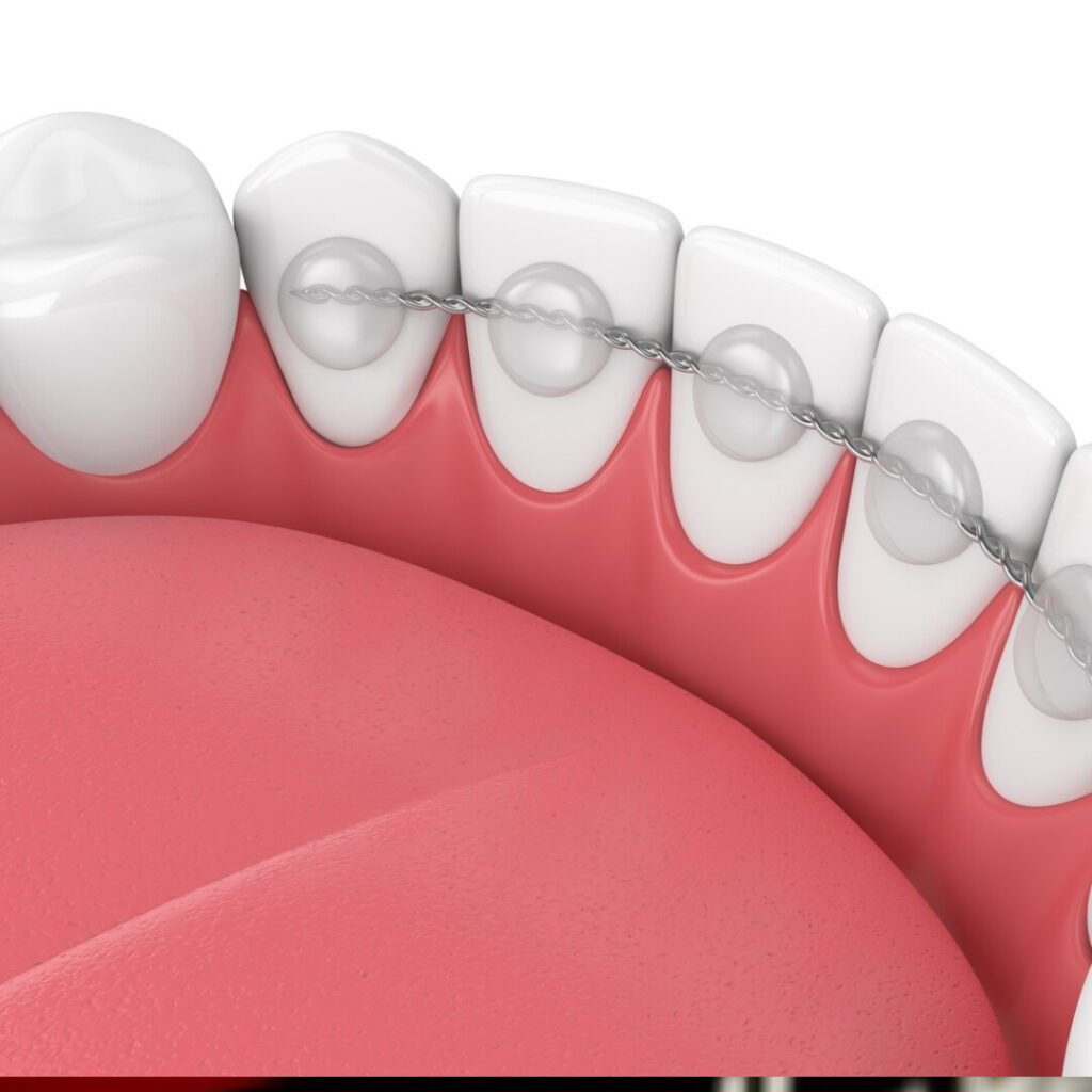 Bandes Molaires Orthodontiques Préformées Avec Boucle - Lot De 4 - Pour 1ères Et 2èmes Molaires - Support D'espace Dentaire