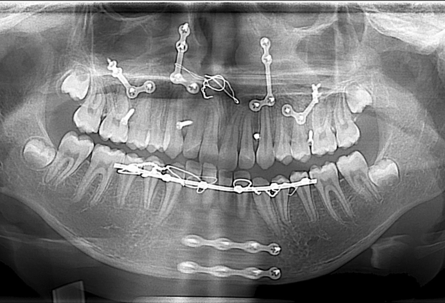 03-04-2017 radiographie Panoramique après un trauma dento-maxillo facial et prise en charge hospitalière copie