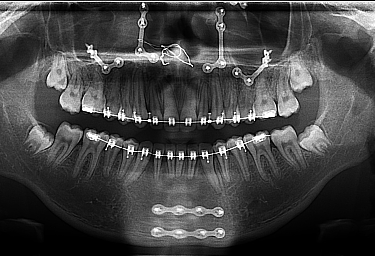 16-10-2020 radiographiepanoramique de fin de traitement orthodontique copie
