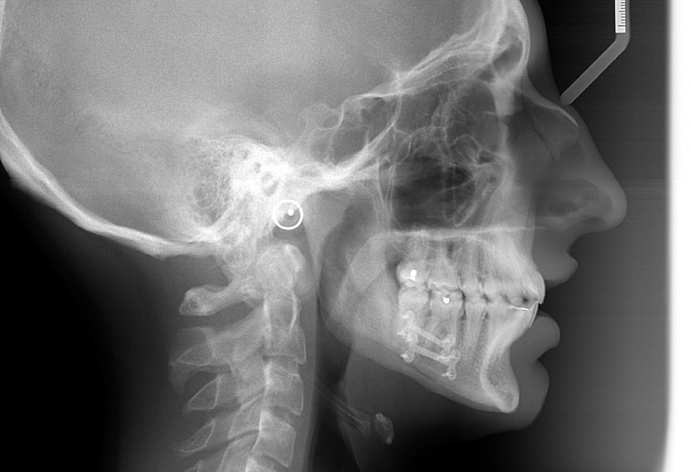 30-03-2012 Téléradiographie de Profil de Fin de traitement orthodontico-chirurgical copie