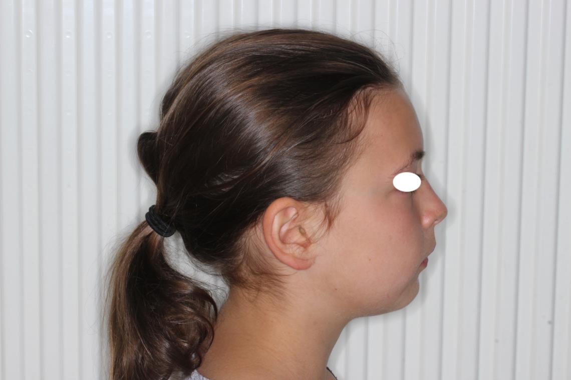 ADULESCENT TRAITEMENT ORTHODONTICO CHIRURGICAL OSTEOTOMIE SAGITTALE DE PROPULSION DES BRANCHES MONTANTES MANDIBULAIRES 1