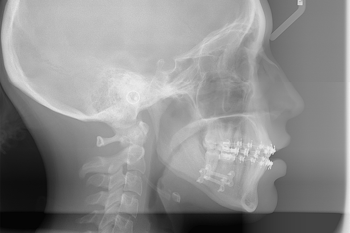 ADULESCENT TRAITEMENT ORTHODONTICO CHIRURGICAL OSTEOTOMIE SAGITTALE DE PROPULSION DES BRANCHES MONTANTES MANDIBULAIRES 4 copie