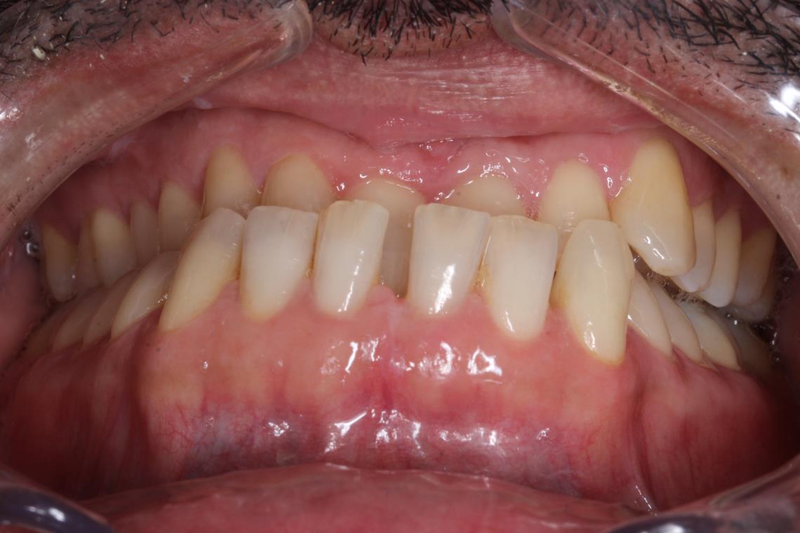 ADULTE CLASSE III TRAITEMENT ORTHODONTICO CHIRURGICAL 1