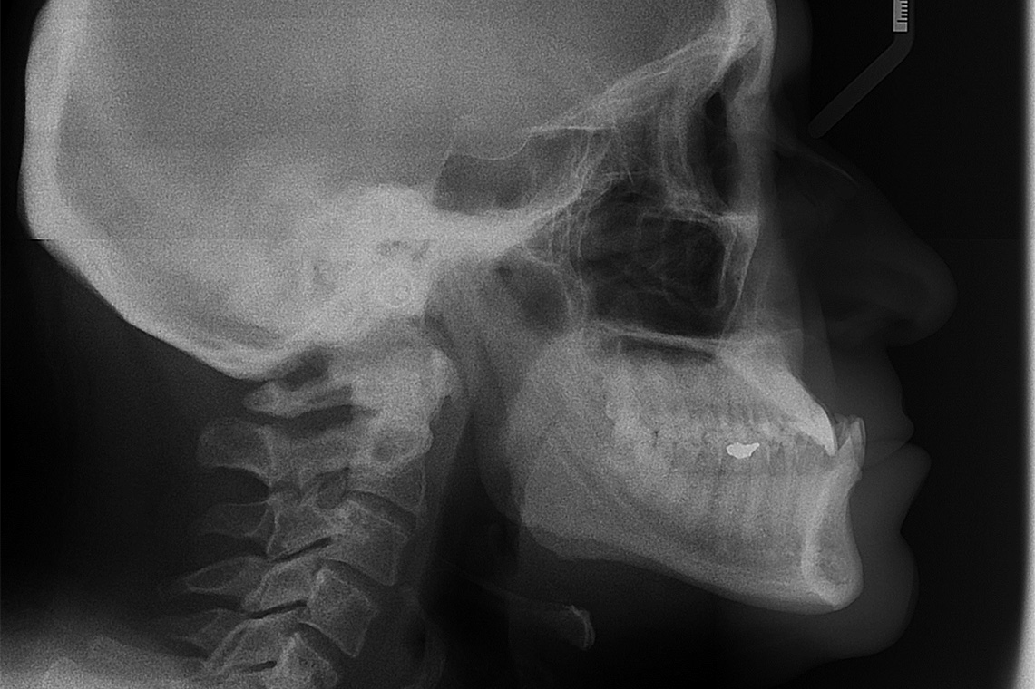 ADULTE CLASSE III TRAITEMENT ORTHODONTICO CHIRURGICAL 5