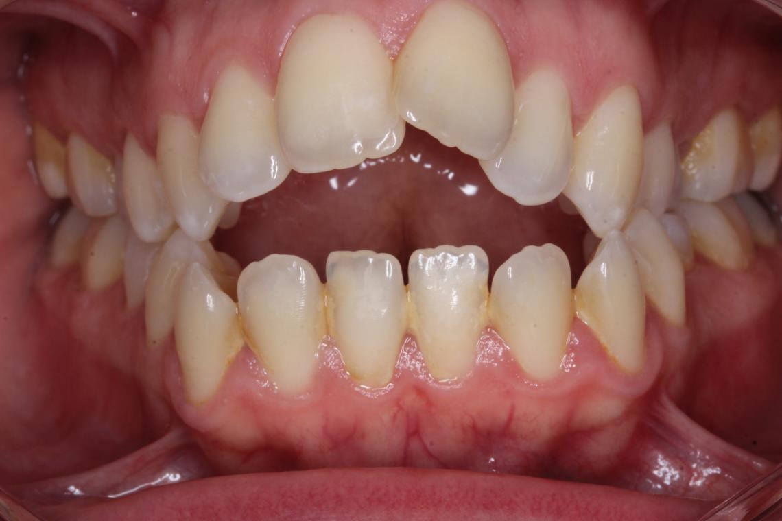 CLASSE I HYPER DIVERGENTE SQUELETTIQUE TRAITEMENT ORTHODONTIQUE ET CHIRURGIE BI MAXILLAIRE 1