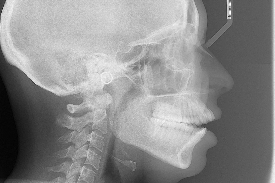 CLASSE I HYPER DIVERGENTE SQUELETTIQUE TRAITEMENT ORTHODONTIQUE ET CHIRURGIE BI MAXILLAIRE 13