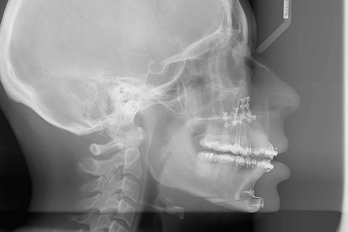 CLASSE I HYPER DIVERGENTE SQUELETTIQUE TRAITEMENT ORTHODONTIQUE ET CHIRURGIE BI MAXILLAIRE 14