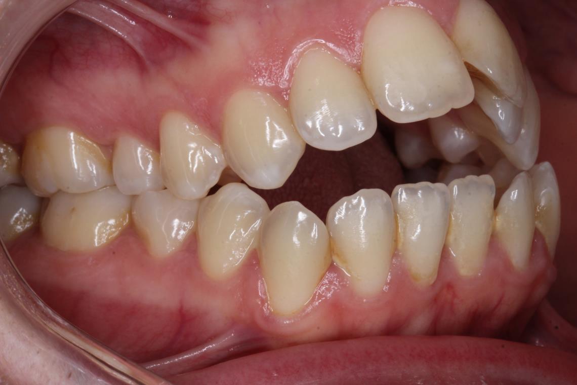 CLASSE I HYPER DIVERGENTE SQUELETTIQUE TRAITEMENT ORTHODONTIQUE ET CHIRURGIE BI MAXILLAIRE 3