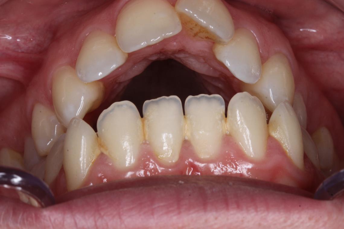 CLASSE I HYPER DIVERGENTE SQUELETTIQUE TRAITEMENT ORTHODONTIQUE ET CHIRURGIE BI MAXILLAIRE 5