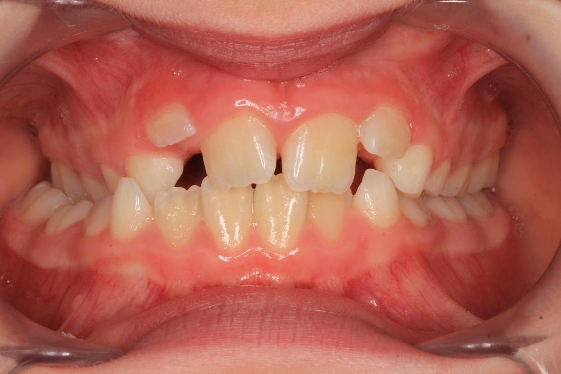 ENDOGNATIE MALOCCLUSION DE CLASSE II 1