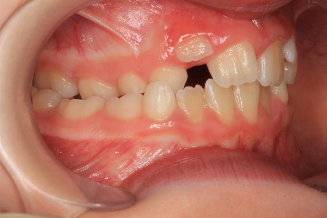 ENDOGNATIE MALOCCLUSION DE CLASSE II 2