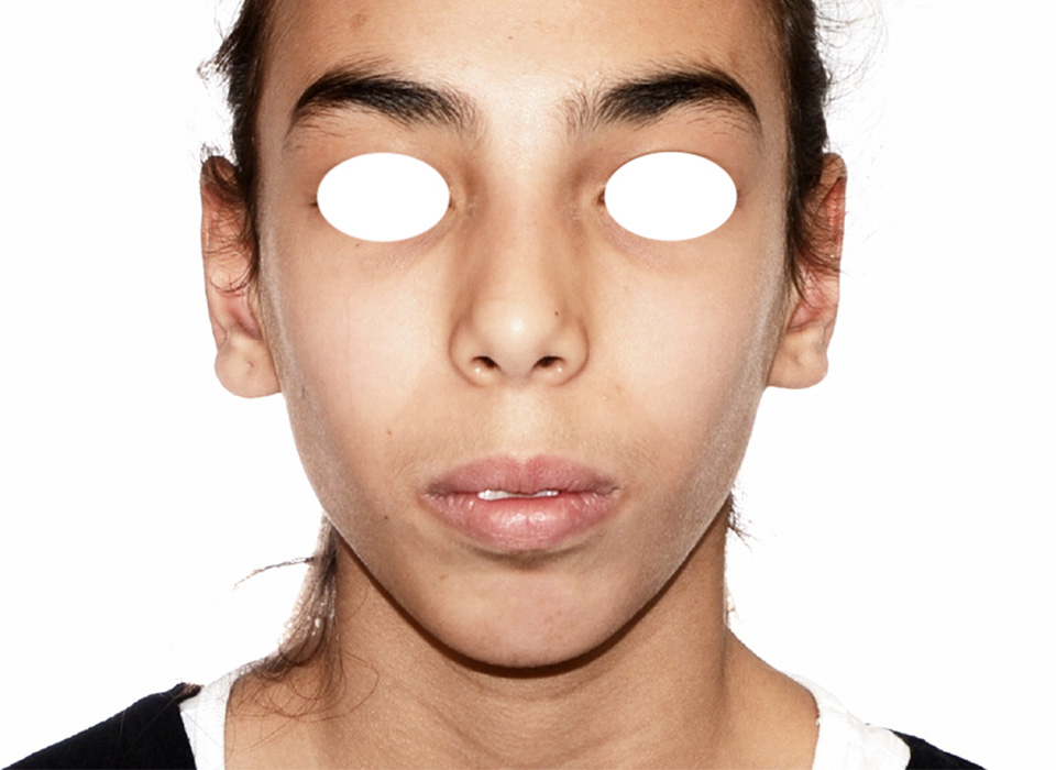 Face avant traitement orthodontico-chirugical