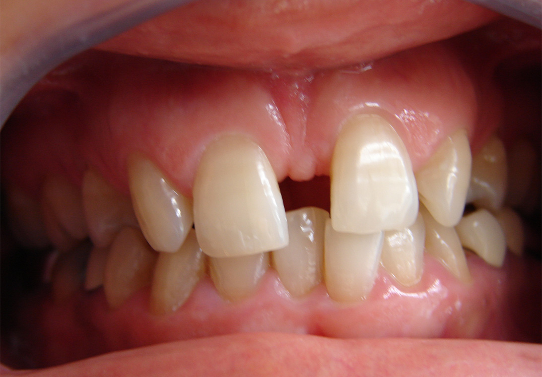 ORTHODONTIE AU SERVICE DE L IMPLANTOLOGIE 1