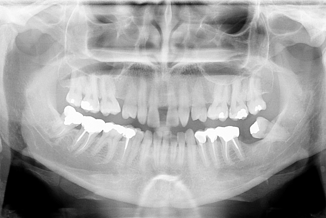 ORTHODONTIE AU SERVICE DE L IMPLANTOLOGIE 3