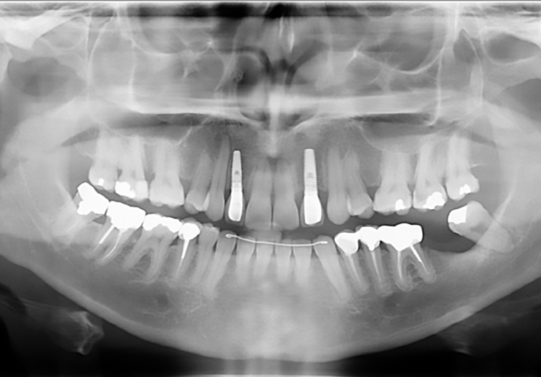 ORTHODONTIE AU SERVICE DE L IMPLANTOLOGIE 4 -1
