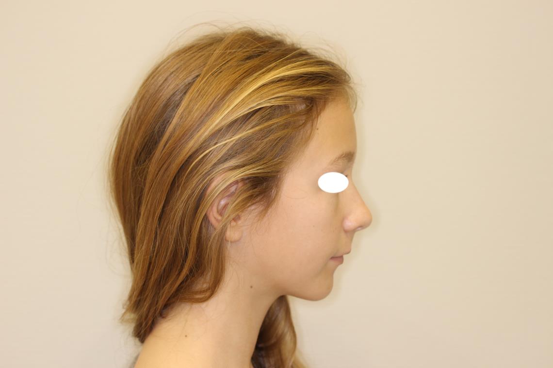 PRISE EN CHARGE ORTHODONTIQUE CHIRURGICALE D UNE MALOCLUSION DE CLASSE II DIVISION II AGENESIE D UNE INCISIVE MANDIBULAIRE SUR UN SCHEMA SQUELETTIQUE BI RETRONATE 1