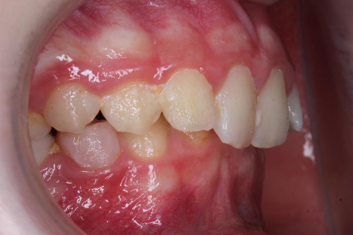 PRISE EN CHARGE ORTHODONTIQUE CHIRURGICALE D UNE MALOCLUSION DE CLASSE II DIVISION II AGENESIE D UNE INCISIVE MANDIBULAIRE SUR UN SCHEMA SQUELETTIQUE BI RETRONATE 3