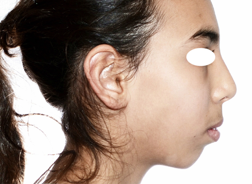 Profil avant traitement orthodontico-chirurgical