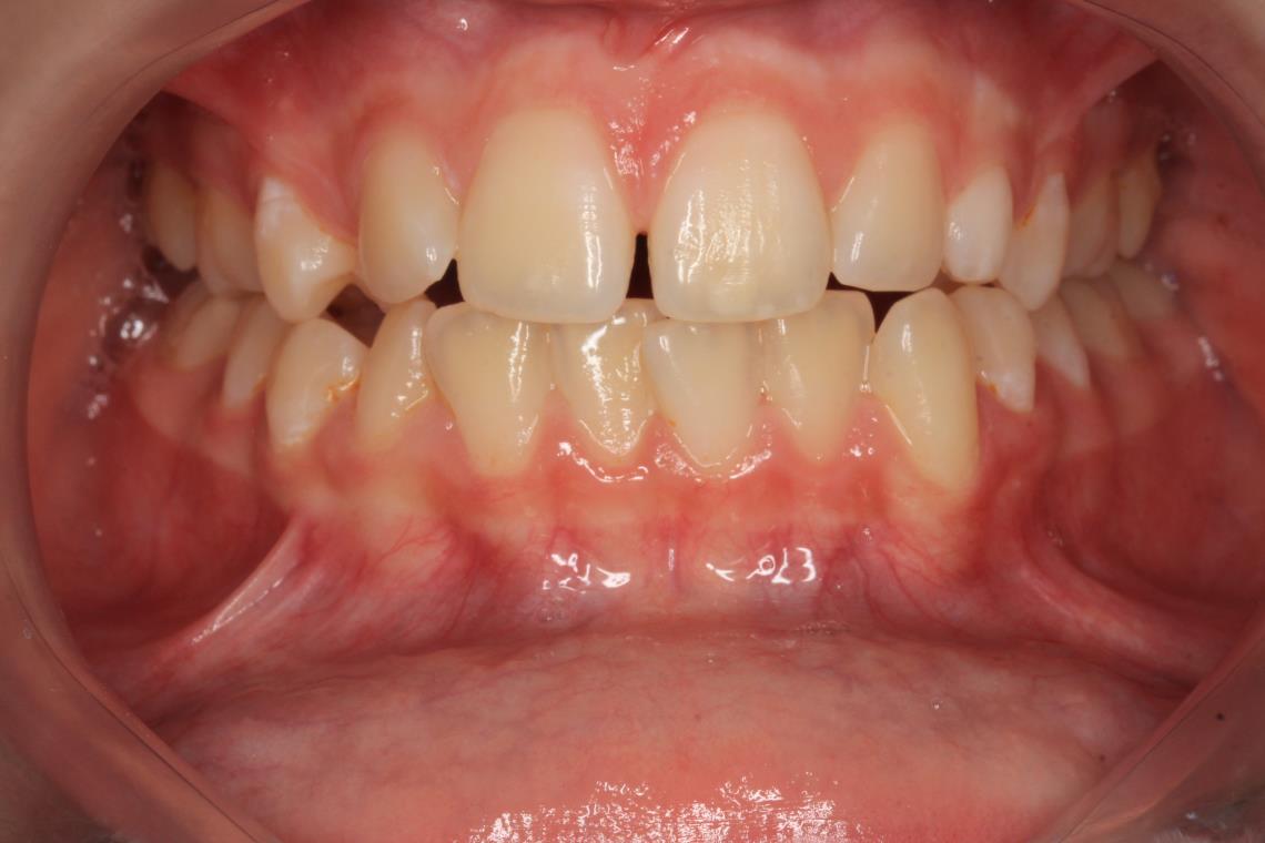 TRAITEMENT ORTHODONTIQUE DANS LA PRISE EN CHARGE D UN CAS COMPLEXE RHIZALYSE CANINE INCLUSE ET TRANSPOSITION 1