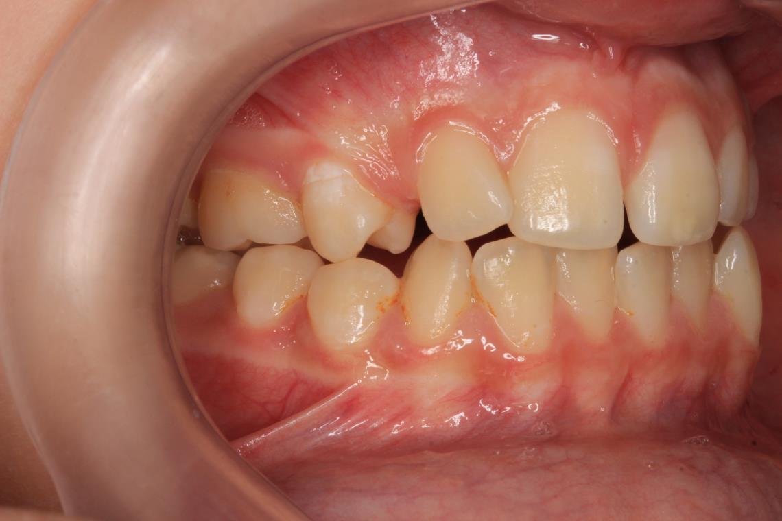 TRAITEMENT ORTHODONTIQUE DANS LA PRISE EN CHARGE D UN CAS COMPLEXE RHIZALYSE CANINE INCLUSE ET TRANSPOSITION 2