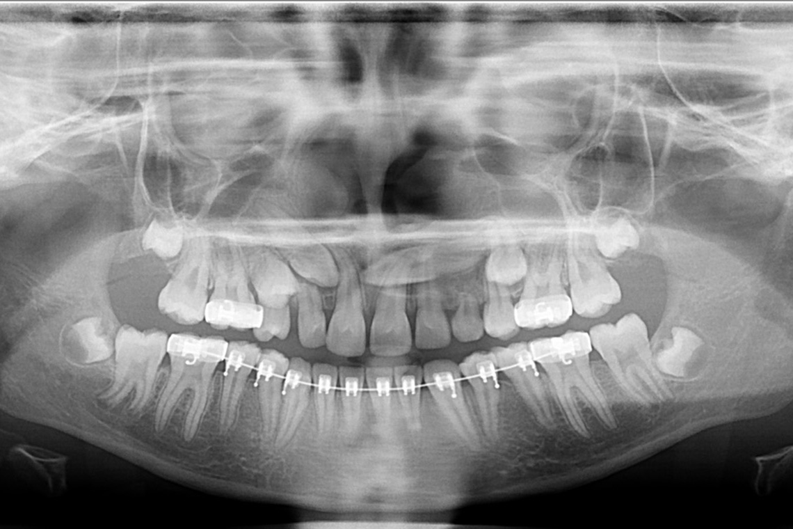 TRAITEMENT ORTHODONTIQUE DANS LA PRISE EN CHARGE D UN CAS COMPLEXE RHIZALYSE CANINE INCLUSE ET TRANSPOSITION 8 copie