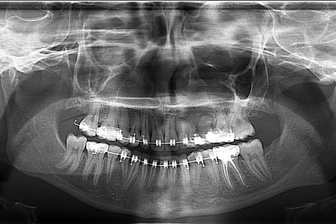 TRAITEMENT ORTHODONTIQUE DANS LA PRISE EN CHARGE D UN CAS COMPLEXE RHIZALYSE CANINE INCLUSE ET TRANSPOSITION 9 copie