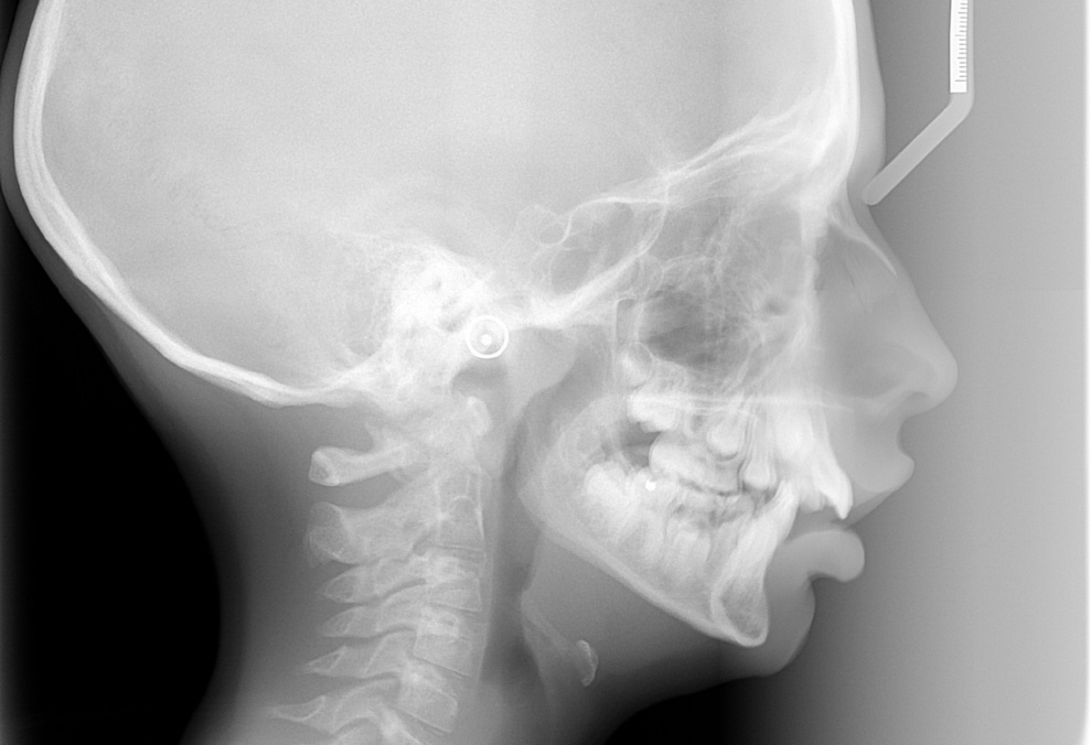Téléradiographie de Profil avant traitement orthodontico- chirurgical copie