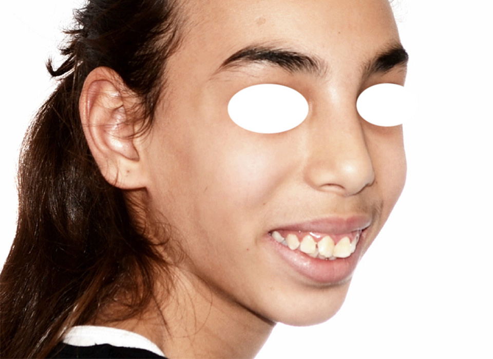 Visage avant traitement orthodontico-chirurgical